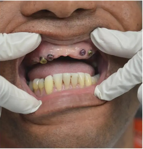 Before — upper arch restored with Full-Mouth Implants at Dental Starz
