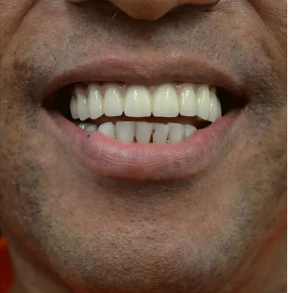After — fixed, natural-looking upper arch Full-Mouth Implant smile at Dental Starz
